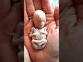 Mom Delivers Baby, But 6 Weeks Later Doctors Find His Deadly Unborn ‘Twin’ Hidden Inside 💔 #shorts