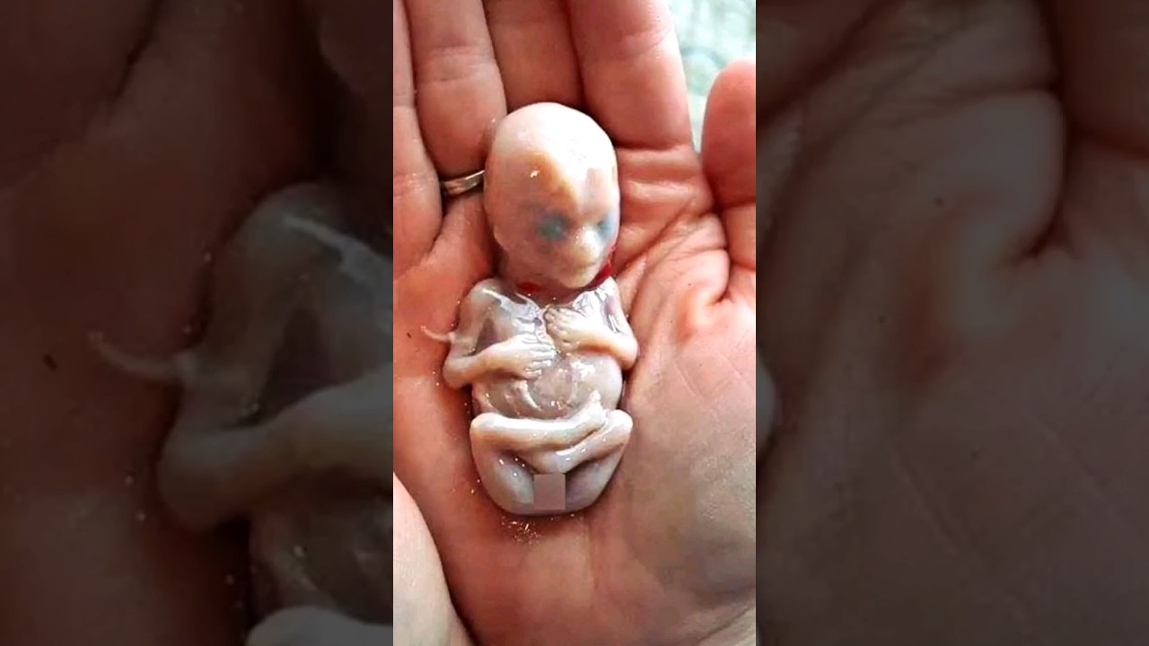 Mom Delivers Baby, But 6 Weeks Later Doctors Find His Deadly Unborn ‘Twin’ Hidden Inside 💔 #shorts