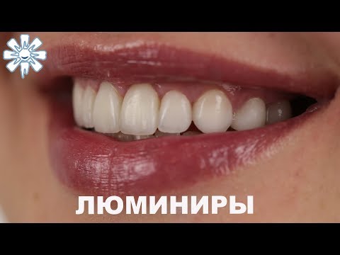 Люминиры фото до