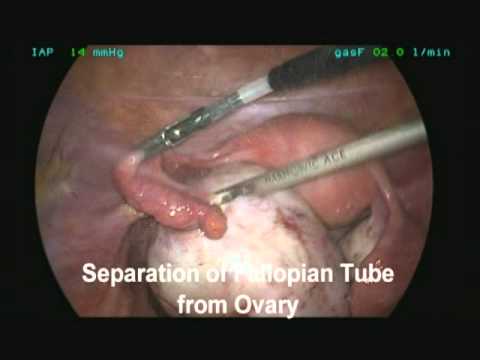 Laparoscopic Resection of an Ovarian Endometrioma