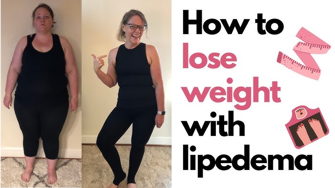 Achieve Weight Loss With Lipedema A 2024