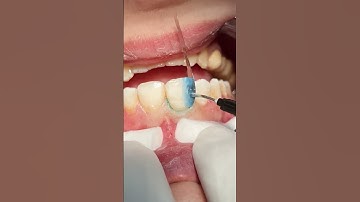 Composite restoration #dentist #dental #composite