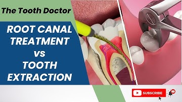 Root Canal Vs Tooth Extraction