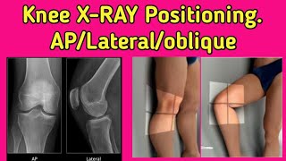 Knee Joint X-ray Positioning // UdayXray