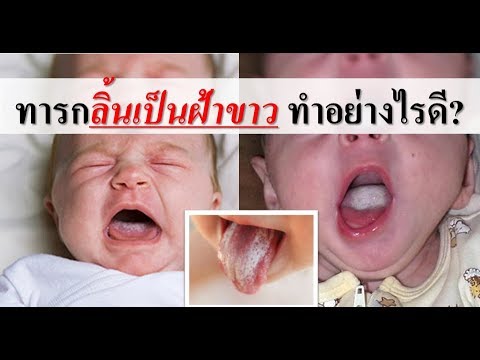 วีดีโอ: ตัดแต่งบังเหียนบนลิ้นเมื่ออายุเท่าไหร่