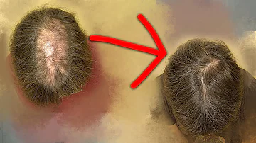 ¿Puede volver a crecer de forma natural el cabello perdido?