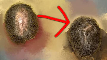 ¿Puede volver a crecer el pelo caído?