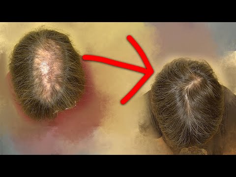 Video: Cómo volver a crecer el cabello después de la caída del cabello (mujeres) (con imágenes)