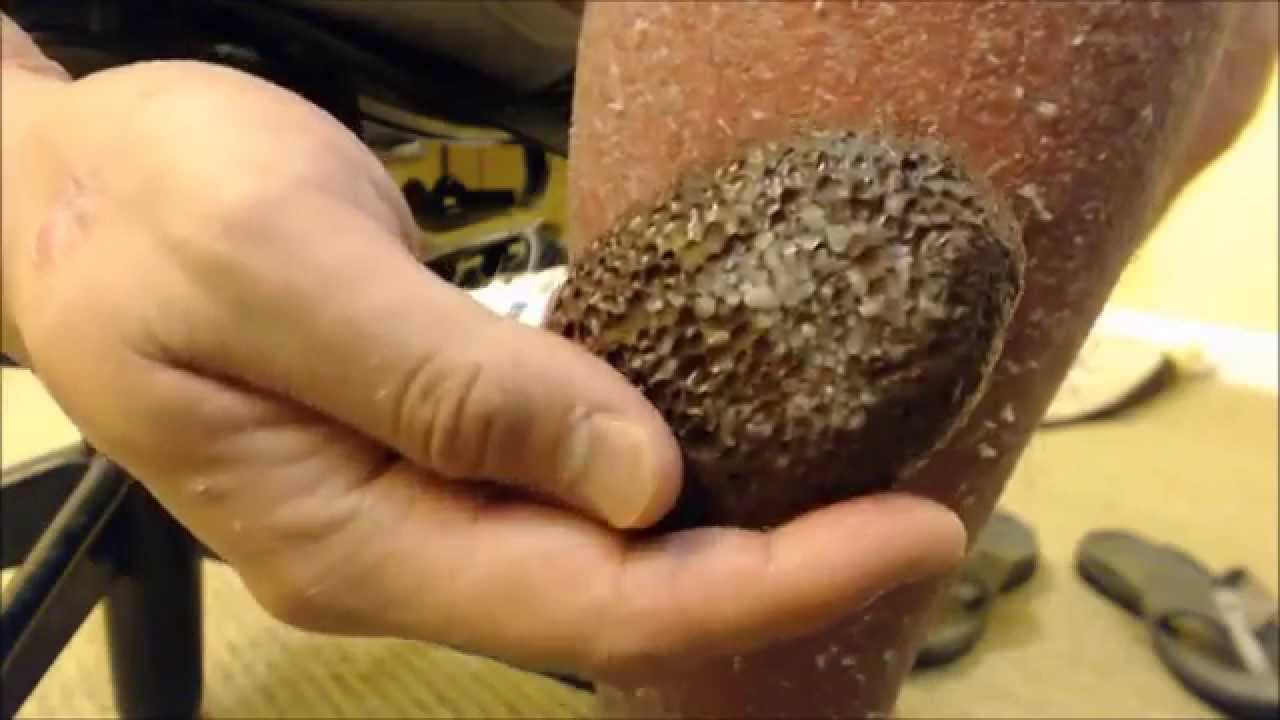 LAVA PUMICE STONE VS PSORIASIS - YouTube