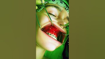 Maxillary Osteotomy Procedure 3D  animation #drone #theflash #space #automobile