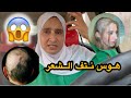 معانات مع متلازمة نتف الشعرلا ارادي كيف تخلصت من هوس نتف شعر واش هاد لمرض عندو علاج Trichotillomanie معانات مع متلازمة نتف الشعرلا ارادي كيف تخلصت من هوس نتف شعر واش هاد لمرض عندو علاج Trichotillomanie