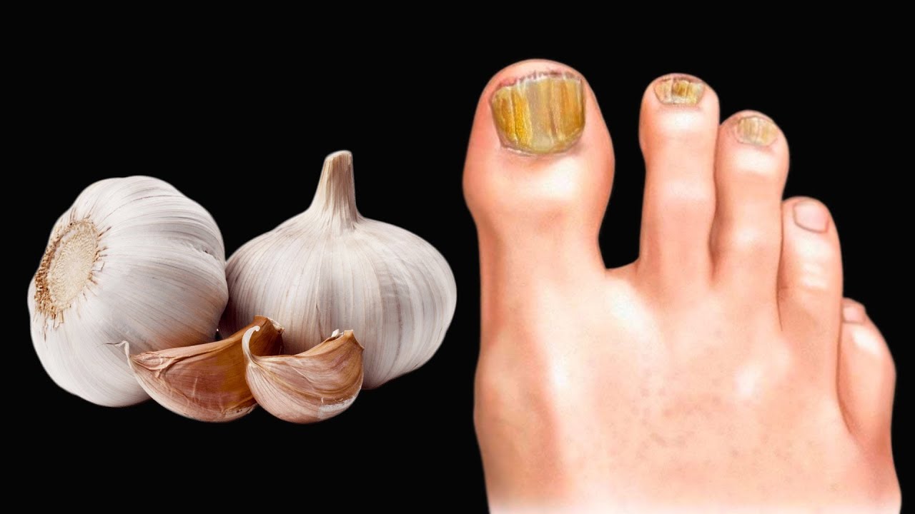 🔥Мгновенно устраняет грибок ногтей. Лучшее средство против грибков и паразитов. Польза чеснока.