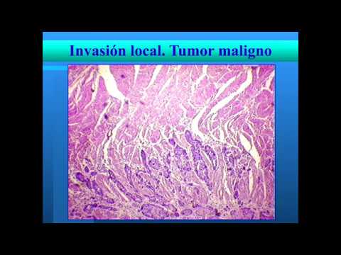 Vídeo: Inmunidad Sistémica Y Local Tras La Transferencia Adoptiva De Células T SPEAR NY-ESO-1 En Sarcoma Sinovial