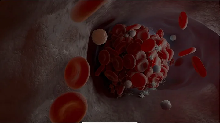 Beating a deadly blood clot: How thrombectomy saved Marnie's life