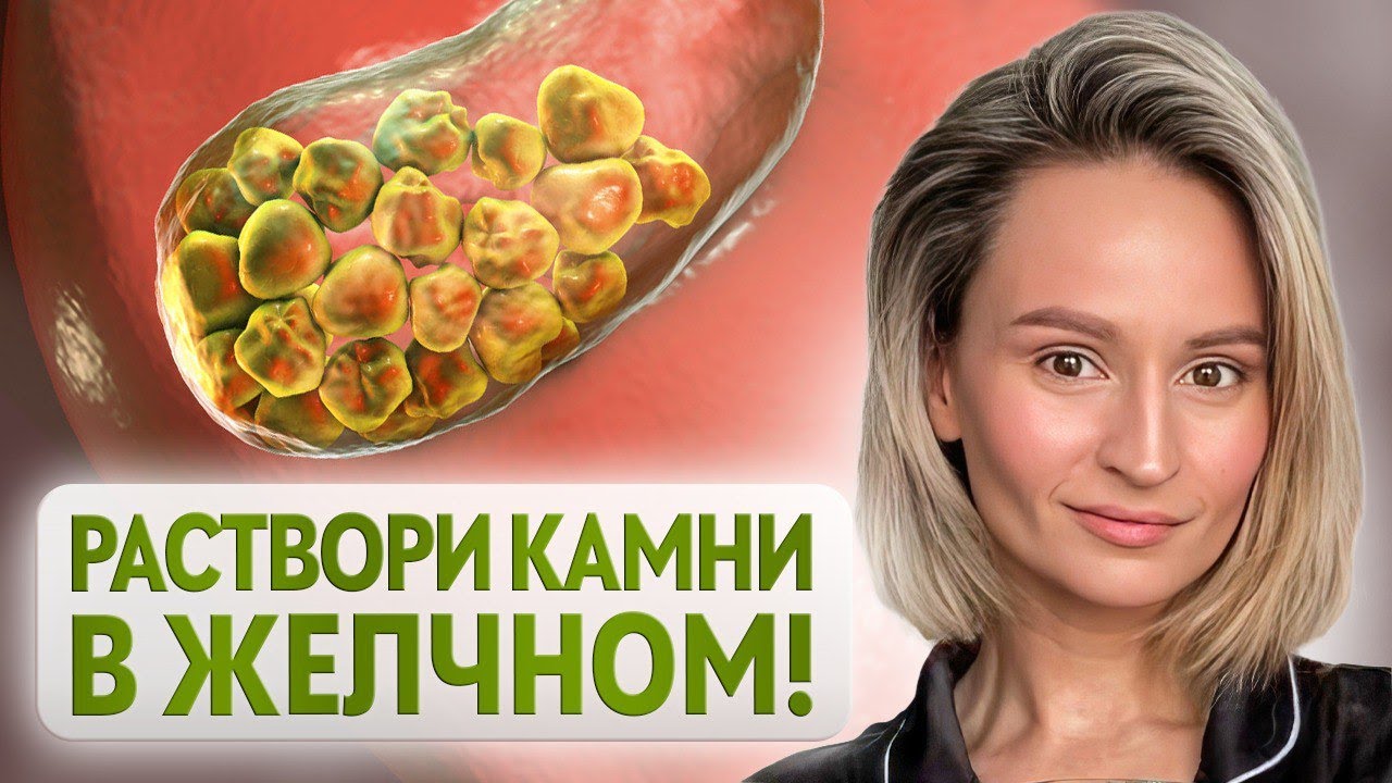Как убрать камни в желчном? Лечение без операции. - YouTube