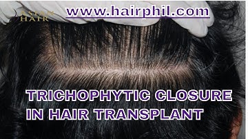 Trichophytic Closure in hair transplant