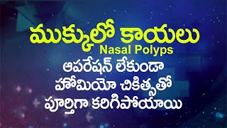 homeo treatment telugu - Nasal polyps | Tumors Homoeo treatement | radhakrishna homeo guntur