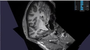 MRI obliquing with webgl2 3D texture - Pixpipe & BabylonJS