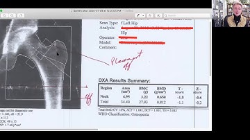 Bone Density Test Errors: DXA Case Study #1