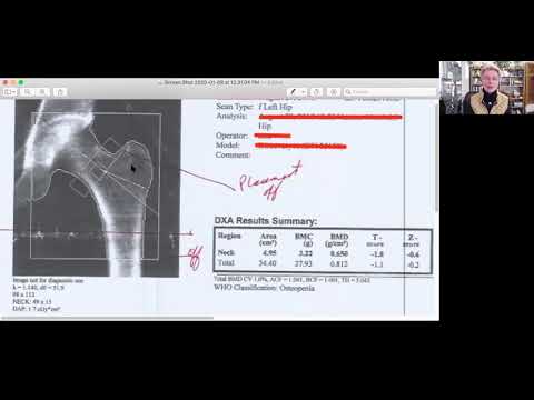 Bone Density Test Errors: Dxa Case Study 1