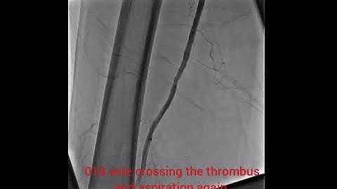 aspiration thrombectomy using the #penumbra#