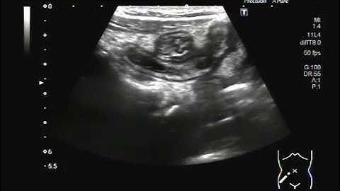 Ultrasound Video showing Localization of Inflamed Appendix.