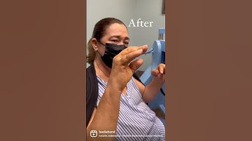 Rheumatoid arthritis case : before and after fusion !