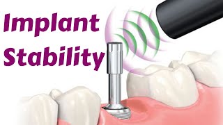 Implant Stability Primary Vs Secondary Stability, Insertion Torque- Dental Implant Lecturecourse