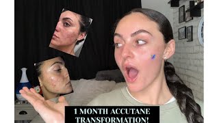 one month on accutane...everything you need to know.