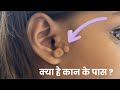 कान के पास जन्म से मांस का उभार? Ear Tag क्या है और इलाज क्या है? अपने सवाल Comment में पूछे । #ear