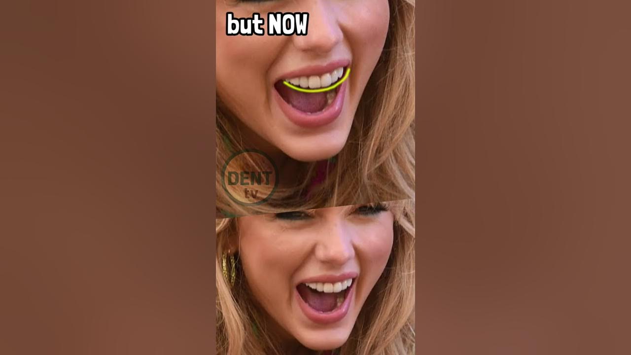 Taylor Swift teeth then and now before and after surgery tooth