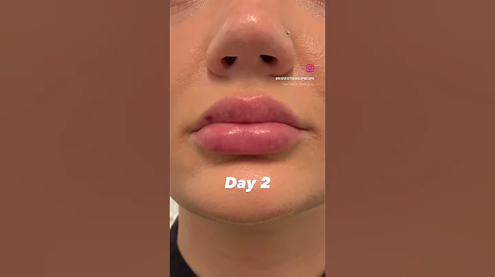 Lip Filler Progress Photos