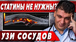 НУЖНЫ ЛИ СТАТИНЫ?! УЗНАЙ ПО УЗИ СОСУДОВ ШЕИ - БРАХИОЦЕФАЛЬНЫХ АРТЕРИЙ!