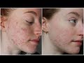 Roaccutane Progress Vlog | Month 2 &amp; 3