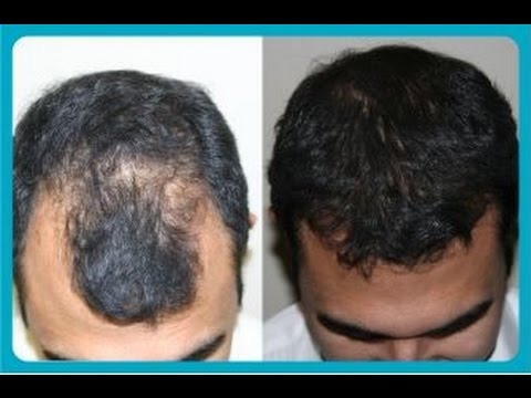 remedio para ajudar crescer cabelo