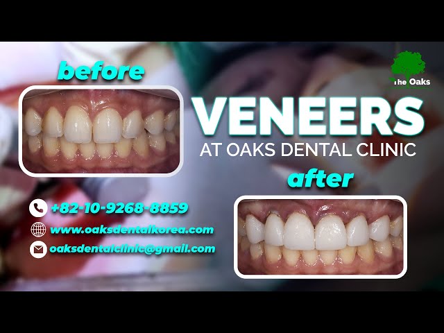VENEERS at Oaks Dental Clinic