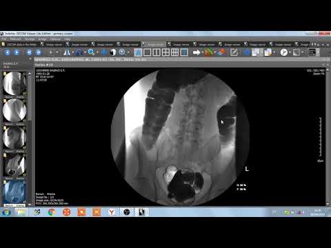 ИРРИГОСКОПИЯ  ИРРИГОГРАФИЯ  РЕНТГЕНОГРАФИЯ