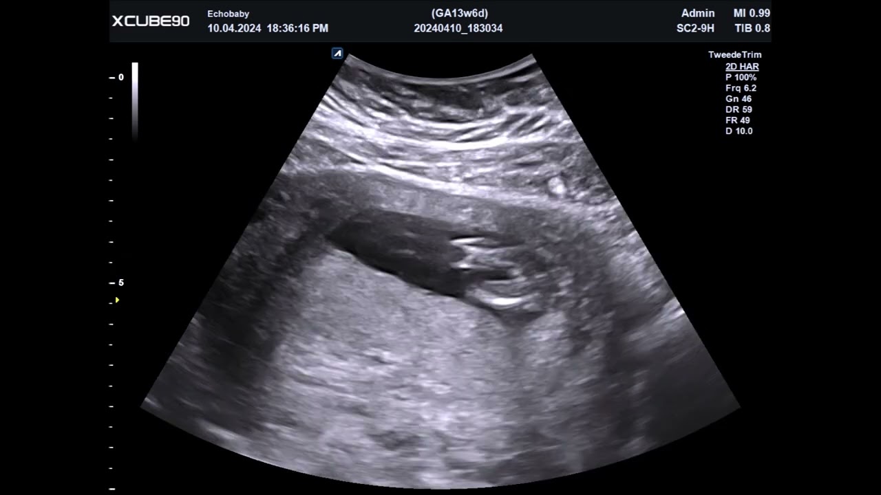 14 Weken Echo Geslachtsbepaling Meisjes