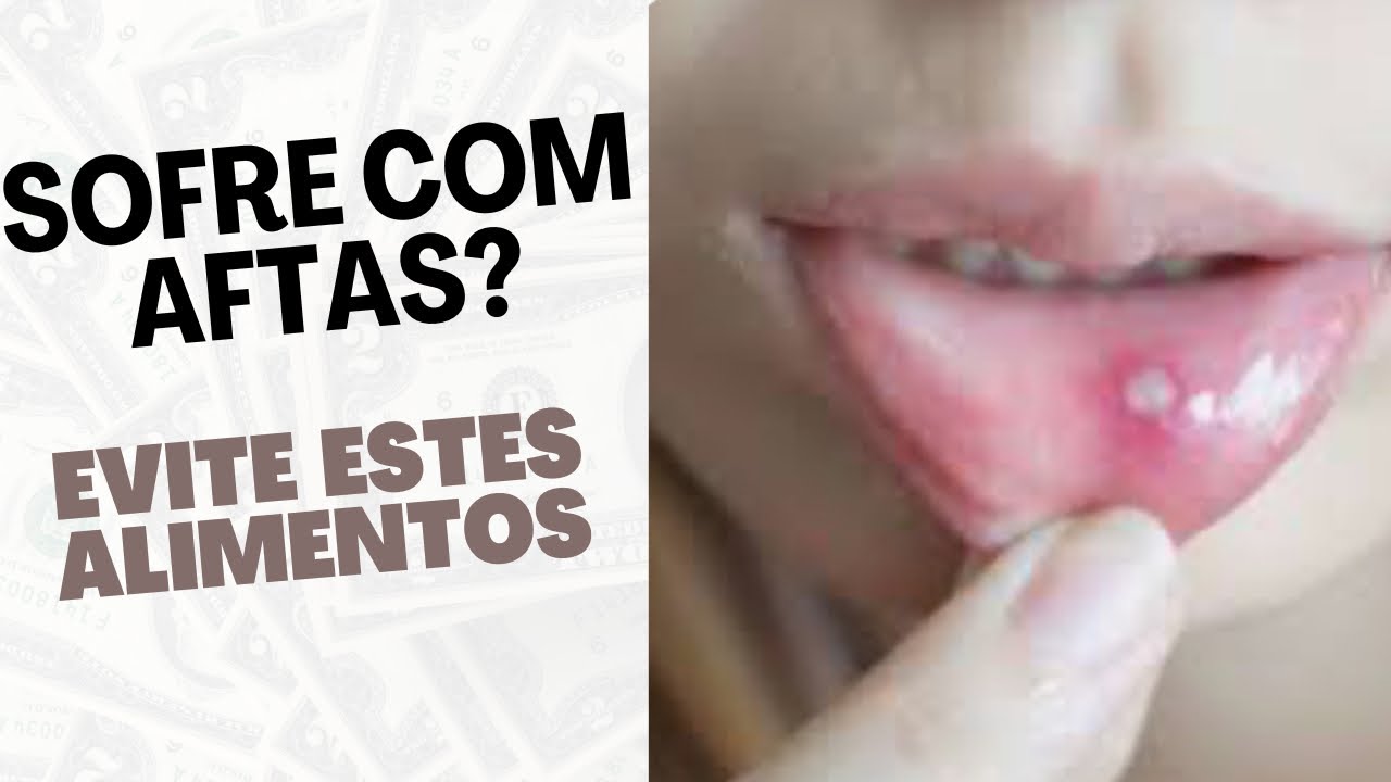 Tenho afta com frequência - O que fazer? Quais alimentos e bebidas ...