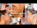 Como tirar manchas de acne do rosto com PEELING QUÍMICO + Atualizações da minha pele