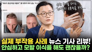 ※실제 뉴스 기사 리뷰※ 모발 이식 후 발생하는 부기의 정도와 빠른 회복 방법은?_[모발이식, 탈모 해결사]