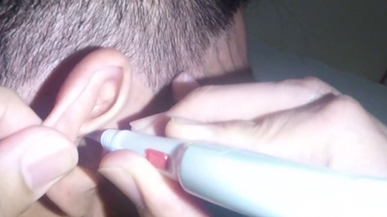 Earwax Removal with Ear Curette & Ear Suctioning YouTube