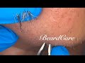 ASMR Precision Plucking: Satisfying Short Hair Removal for Perfect Clean Skin | Relaxing