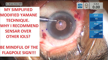 My Simplified Modified Yamane Technique. Why Do I Recommend Sensar IOL? Watch for the Flagpole Sign!