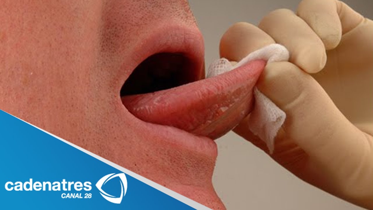 Cancer bucal sintomas y signos. Sintomi papilloma virus in gola