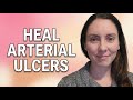 How to Heal Arterial Ulcers | Assessment & Care Guide