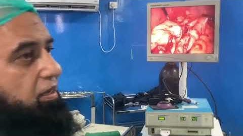 SLEEVE GASTRECTOMY PERFORMED for educational purposes. 