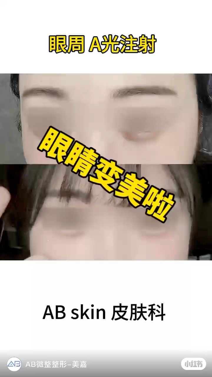 黑眼圈太重？這支針讓你瞬間有精神 #shorts