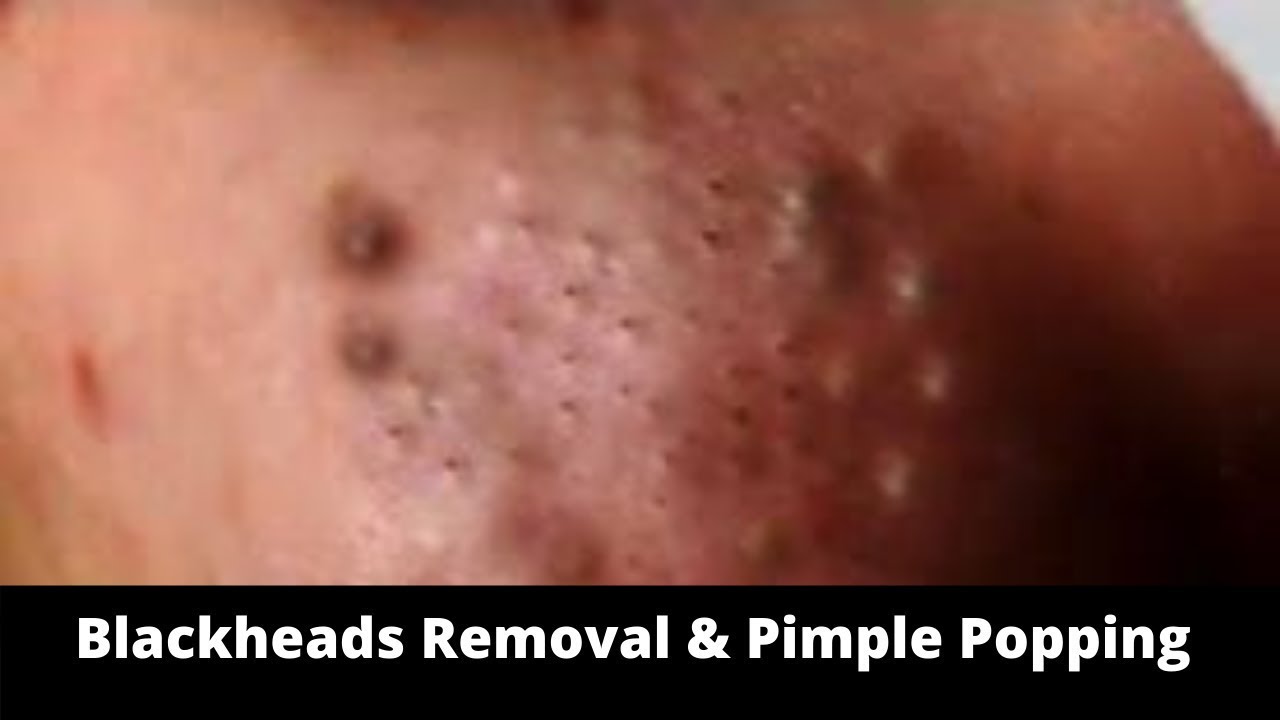 Blackheads Removal & Pimple Popping Videos 2021 YouTube