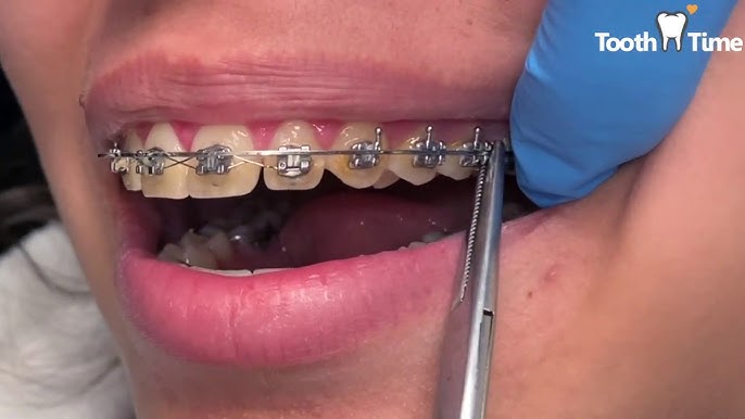 Braces wires - from wire 016 to a niti 18x25 - Tooth Time Family Dentistry  New Braunfels 
